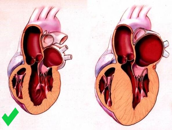 Cardione previene la hipertrofia ventricular del corazón